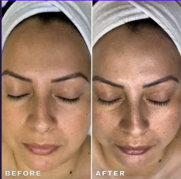 Microdermabrasion treatment