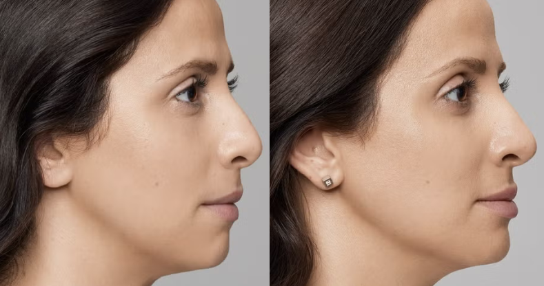 Non-Surgical Rhinoplasty